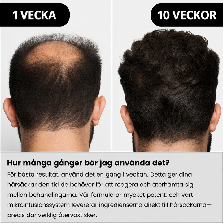 AlphaInfuse™ Hårtillväxtsystem