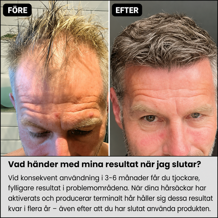 AlphaInfuse™ Hårtillväxtsystem